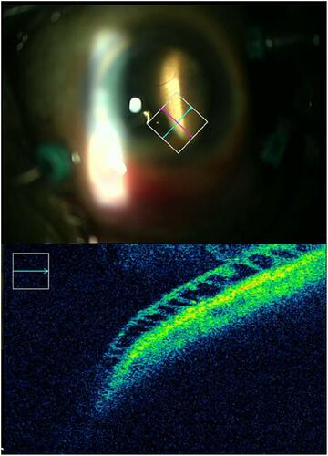 Figure 3 Peripheral cystoid degeneration in attached retina assessed by intraoperative optical coherence tomography (a 60-year-old-male).