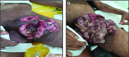 Figure 2. Rapid tumor evolution from September 2022 (A) to December 2023 (B).