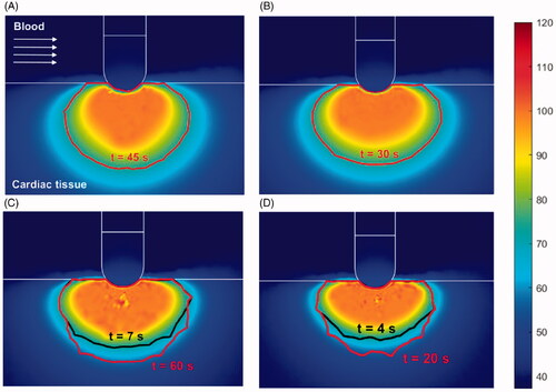 Figure 4. Temperature distribution (°C) and thermal lesions created in cardiac tissue with the catheter in the perpendicular orientation by a standard ablation protocol of 20 W–45 s (A) and 30 W–30 s (B), and also an HP-SD ablation protocol of 70 W–7 s (C) and 90 W–4 s (D). The thermal lesion was assessed by the Arrhenius contour Ω = 1 after RF ablation time (red solid line in A and B and black solid line in C and D together with ablation time) and after the extra thermal expansion caused by thermal latency in the cooling period (red line in C and D together with the minimum time required to reach it.).