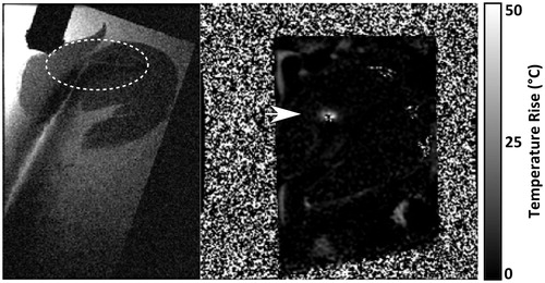 Figure 3. (Left) Magnitude MRI image showing a steerable, MR-compatible endovascular HIFU catheter in an ex vivo porcine heart (white ellipse indicates catheter tip). (Right) MR thermometry image in a plane normal to the catheter tip showing the temperature rise in the heart wall. Courtesy of M. Carias.