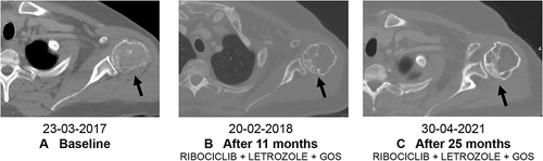 Figure 11 CT scan with bone windows. (A) Humerus shows a lytic lesion into the posterior humeral head, the cortical part of the humerus head is conserved, (B) area of osteosclerosis into the previous lytic lesion, as response to treatment, (C) further osteosclerosis area in relation to the partial recalcification of the lesion.