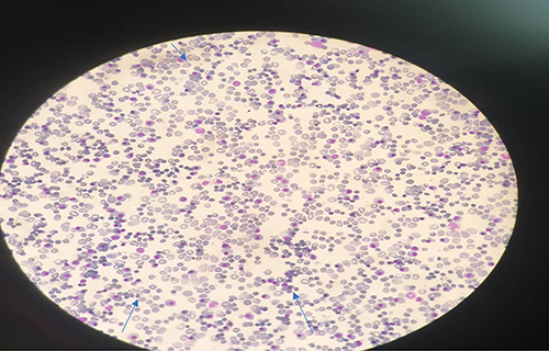 Figure 2 Peripheral morphology revealed normoblasts and immature white blood cell.