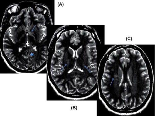 Fig. 1. Axial T2 sequences of the brain demonstrate extensive multiple bilateral hyper-intense lesions within the (A) left basal ganglia (arrow) and splenium of the corpus callosum (arrowhead); (B) the bilateral internal capsules (arrows) and (C) within the bihemispheric white matter diffusely and more focally within the right corona radiate (arrow). The lesions are compatible with a demyelinating process. Lymphoma and infection are considered less likely given the lack of enhancement with gadolinium administration (See colour version of this figure in the online version www.informahealthcare/ctx).