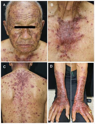 Figure 1 Multiple dusky red to brownish papules and patches covered by scales and crusts with some erosions predominately on face (A), upper chest (B), back (C), and dorsum of both forearms (D).