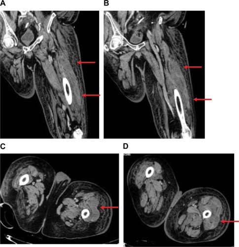 Figure 3 (A, B) CT-scan of left lower extremity, coronal sections showing abscess spanning the length of the vastus lateralis muscle. (C, D) Axial slices showing extent of abscesses. Red arrows indicate abscesses in vastus lateralis muscle.