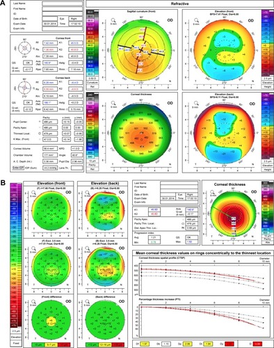 Figure 2 Preoperative corneal tomography of a patient seeking refractive correction; −3.50 D. Corneal tomography demonstrates an inferior superior asymmetry (A) with an overall D of red (B).