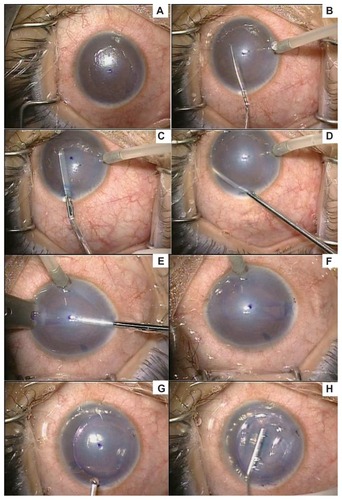Figure 2 (A) intraoperative view of cornea after debridement of corneal epithelium; (B) scouring of Descemet’s membrane using a reverse Sinskey hook; (C) stripping of Descemet’s membrane from the overlying corneal stroma with a 90° Descemet’s stripper; (D) performing a peripheral iridectomy with a vitrector; (E) pulling the endothelial graft into the anterior chamber; (F) unfolding of the graft in anterior chamber; (G) an air bubble is injected under the graft; (H) centration of the donor disc by massaging the epithelial surface of the cornea with an irrigating cannula.