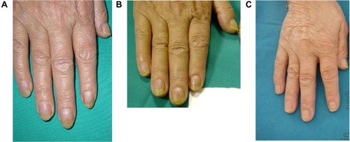 Figure 7 Nail plate crumbling, hyperkeratosis, and splinter hemorrhage improved after 24 weeks and resolved after 27 months compared to baseline.