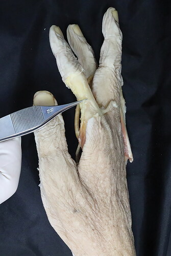 Figure 4. This reveals the insertion of the accessory first lumbrical muscle of the right index finger.