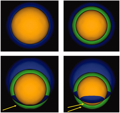 Figure 2. Categorization of post-ablation outcomes. Top left: Tumor (inner part) entirely included in the necrosis (outer part). Top right: Tumor (inner part) and 5 mm safety margin (middle part) entirely included in the necrosis (outer part). Bottom left: Tumor (inner part) entirely included in the necrosis (outer part), 5 mm safety margin (middle part) partially included in the necrosis. Arrow indicates the safety margin region not included in the necrosis. Bottom right: Tumor (inner part) and 5 mm safety margin (middle part) partially included in the necrosis (outer part). Arrows indicate the tumor region and the safety margin region not included in the necrosis.