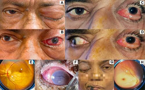 Figure 1 Clinical manifestations of patients with COVID-19 associated mucormycosis. (A and B) Left eye showing proptosis and total ophthalmoplegia. (C and D) Left eye showing marked chemosis and total ophthalmoplegia. (E) Bedside fundus image showing right branch retinal artery occlusion. (F) Right-eye endophthalmitis with hypotony and corneal edema. (G) Post liver transplant patient showing right total ophthalmoplegia, icterus and black discoloration of lower lid and lip. (H) Fundus image suggestive of left central retinal artery occlusion.