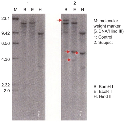 Figure 5 Southern blot analysis. Monoclonal rearranged bands were detected in the immunoglobulin JH region.