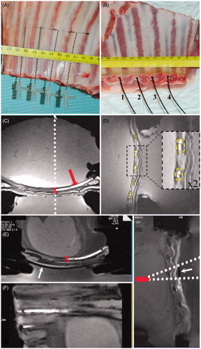 Figure 1. Set-up of ex vivo sample using ‘gold standard’ MR-compatible fluoroptic temperature sensors. (A) Perforating needles inserted into the ribs. (B) Optical fibres (numbered 1 to 4) inserted into the medullar cavity ‘tunnel’. (C) Transverse oblique section in the T1w 3D MR data visualising tagged ‘tunnel’ (see red arrow) in which the fluoroptic sensor was positioned. Note the dotted white line indicating the position of the sagittal slice for MR thermometry tangent to the tip of the tunnel. The location of the fluoroptic probe measurement (the tip of the probe) is identified with red ‘x’ symbol. (D) Sagittal section in the T1w 3D MR data visualising the orthogonal section of the ribs (see dotted yellow ellipses), which were positioned in the pre-focal HIFU zone. (E) Similar to C, but an external mask (white arrow) is visible below the imaged rib, for acoustic shielding. (F) Curved interpolated slice reconstructed from the T1w 3D MR data for a pseudo-planar representation of the thoracic wall and the rib cage. (G) Gradient echo FLASH 2D image orthogonal to the ribs, illustrating the protector (see white arrow indicating the signal void area) aligned using a conical projection from the focal point. Fields of view shown are 128 × 128 mm2 (C), 140 × 140 mm2 (D) with zoom-in insert box by a factor of 2, and 220 × 110 mm2 (G).