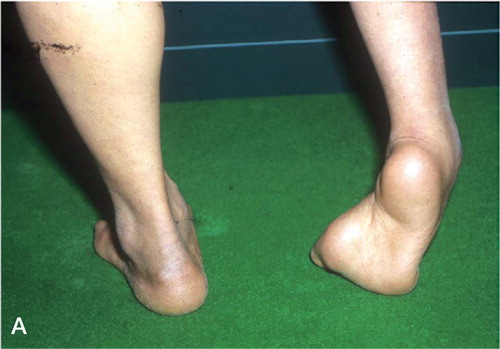 Figure 2 A case of severe equinocavovarus deformity and tibial shortening. A. Preoperative photograph. B. Preoperative radiograph. C. Radiograph showing anterior subluxation of the talus during correction of equinus deformity with the Ilizarov apparatus. D. Photograph after tibial lengthening and correction of the foot, showing plantigrade foot. E. Radiograph of the foot at 10-year follow-up, showing degenerative arthritis of the ankle and recurrent equinus deformity.