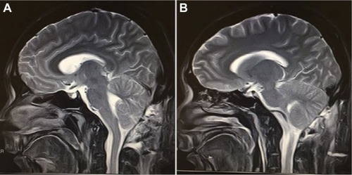 Figure 4 MRI taken during follow-up outpatient visit 3 months after the removal of the iron rod (A and B).