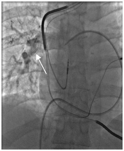 Figure 3 Heart failure sensor implanted through right heart catheterization in the right pulmonary artery (arrow), although left is the preferred location. Flow is noted around the sensor on venogram and the device measures pulmonary pressures. Obtained from Ohio State University Medical Center.