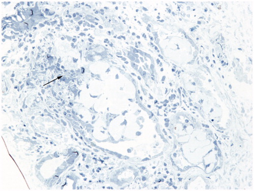 Figure 5. Image from plastic-embedded tissue submitted for electron microscopy shows damaged renal tubule with extravasation of Tamm–Horsfall protein (arrow). Methylene blue, original magnification ×200.