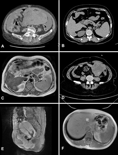 Figure 1 CT and MR images of cases: (A) for CT image of case 1; (B) for CT image of case 2; (C) for MR image of case 2; (D) for CT image of case 2; (E) for MR image of case 3; (F) for MR image of case 3.