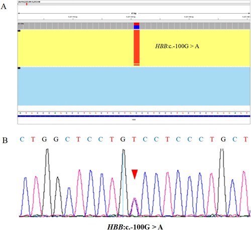 Figure 1. The inconsistent sample as detected by TGS and conventional PCR-RDB technology was verified by Sanger sequencing. (A) The Integrative Genomics Viewer plot of HBB:c.−100G > A variant detected by TGS but not PCR-RDB, and the red boxed area indicates the position of this variant. (B) The Sanger sequencing output profile of the HBB:c.−100G > A variant sequence, and the red arrow indicates the position of this variant.