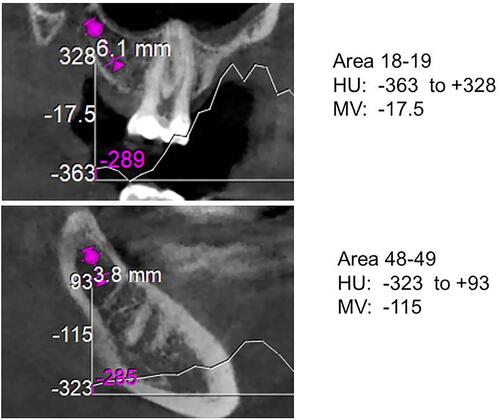 Figure 1 Example of a DVT-HU measurement of a BMDJ following clinical evaluation. The HU attenuation coefficients are shown as a curve over the measured section. In the present validation study, only the mean values (MV) are used.