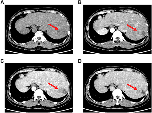 Figure 5 Computed tomography (CT) scans images after course, the focus was smaller than before, the tumor activity was still seen, and there was a little effusion in the operative area (red arrow). (A) Plain scan; (B) Arterial phase; (C) Portal venous phase; (D) Venous phase.
