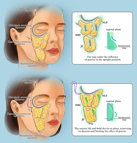 Figure 5 Illustration of the principle behind our fat repositioning technique. The nasolabial, medial cheek, and jowl fat compartments are located medial to the line of ligaments. (Top) With age and under the influence of gravity, the fat in each compartment glides inferiorly to take a water droplet form in the sagittal plane, and the compartments are separated, which manifests in bulging of the jowl and nasolabial areas and the appearance of facial lines and grooves. (Bottom) After fat compartment repositioning, the fat compartments are reconnected and restored into their original state, recovering a semi-spherical shape in the sagittal plane. NLF: nasolabial fat compartment; SMC: superficial medial cheek fat compartment; JF: jowl fat compartment.