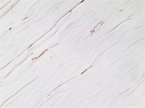 Figure 7. TUNEL-positive cells at time 0 after RF treatment: the staining pattern of fibroblast nuclei appears clumpy and they appear more intensely stained than the controls, indicating thermal damage (original magnification: × 850).