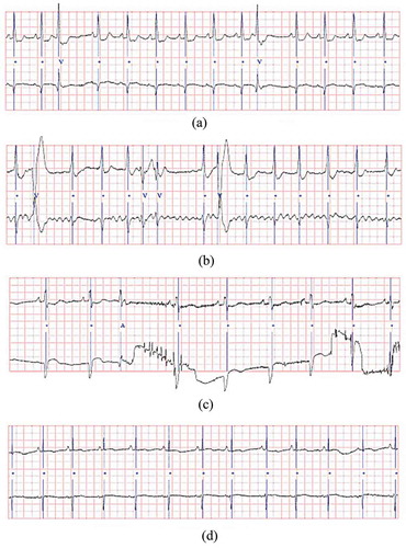 Figure 2. The fragments of ECG signals’ records from the MIT-BIH base: (a) signal 105, (b) signal 108, (c) signal 203, (d) signal 222.