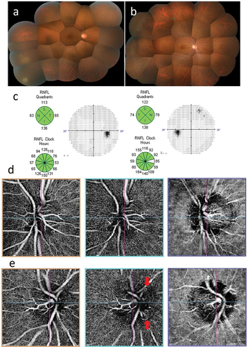 Figure 3. Case 3: Acute retinal necrosis in the right eye. (a) Fundus image of the right eye at presentation. A yellowish white lesion with fusion expansion is observed in inferior temporal retina, and the optic papilla appears reddish. (b) Fundus image of the right eye at 3 months after treatment. The yellowish white lesion has completely disappeared, and the optic papilla appears normal. (c) Optic nerve head analysis by OCT and visual field examination by HFA at 3 months after treatment. show no remarkable abnormalities in both examinations. d and (e) OCTA examination of the optic nerve at 3 months after treatment. OCTA images of the optic nerve head, radial peripapillary capillaris (RPC), and choroid are shown sequentially from the left. (d) No abnormalities are observed in the left eye. (e) in the right eye, looped capillary network is found in RPC (red arrows).