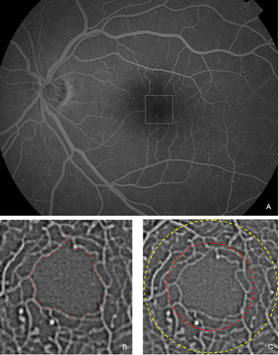 Figure 1 Original FA image (A) of 1900×1472 pixels from the left eye of a 34 year-old female subject with non-proliferative diabetic retinopathy and cropped subimage (B) of 287×287 pixels in which the border of the FAZ was delineated manually (red dots in (B)) to initiate the detection and quantification process. The white dashed square indicates image 1B. The two circular ROIs of 500μm and 750μm radius are depicted in (C) (red and yellow dashed circle, respectively).