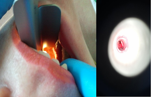 Figure 5 Comparison of glottis view in the same patient using Macintosh blade laryngoscope (left) and the Vie Scope® (right).