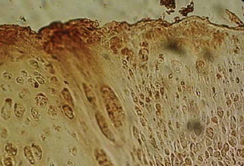 Figure 8. Immunohistochemistry staining of type II collagen observation of bone marrow MSCs group 12 weeks postoperatively (× 1 000).