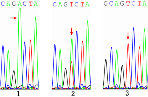 Figure 2 DNA sequence of omentin-1 gene region showing omentin-1 polymorphism in humans. DNA sequencing of the representative samples showing three genotypes (A/A, A/T and T/T) in omentin-1 gene for Val109Asp polymorphism. Among them, A/A genotype (1) is Val/Val genotype, A/T genotype (2) is Val/Asp genotype, T/T genotype (3) is Asp/Asp genotype. In the chromatogram Blue, Black, Green and Red peaks show C, G, A and T nucleotides respectively. The highlighted region in the chromatogram represents the site for Val109Asp polymorphism. Sample 1: GCAGCAAAGCAGA/ACTACCC. Sample 2: GCAGCAAAGCAGT/ACTACCC. Sample 3: GCAGCAAAGCAGT/TCTACCC.