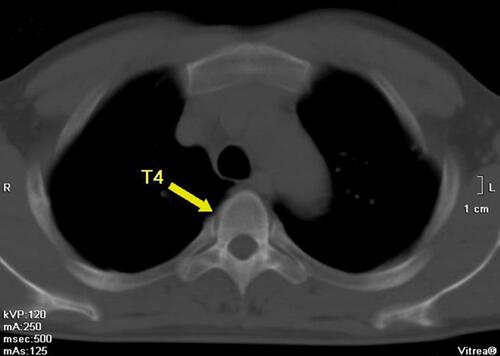 Figure 8 A 16-slice computed tomographic scan revealed that the high-density nodule in the fourth thoracic vertebra was absorbed.