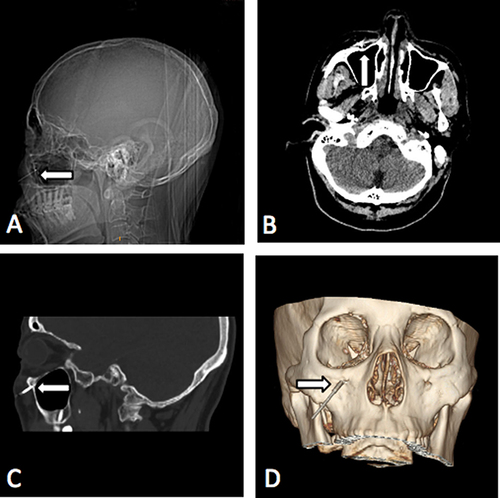 Figure 1 Operative procedure of puncturing the infraorbital foramen. (A) Localization for puncture. (B) The tip of the trocar entering the ipsilateral infraorbital foramen as shown in axial CT scan of maxillary sinus.(C) The needle entering the ipsilateral infraorbital foramen as shown in sagittal CT scan of maxillary sinus. (D) The needle entering the ipsilateral infraorbital foramen as shown in 3-D reconstruction of spiral CT. White marks indicate the needle in the infraorbital foramen.