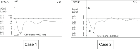 Figure 1 Negative electroretinogram at six months (1991 and 1992). Case 1. White photopic electroretinogram of the right eye. Case 2. White photopic electroretinogram of the left eye.