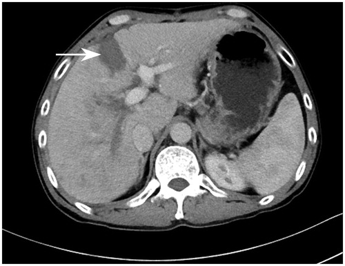 Figure 2. Contrast-enhanced computer tomography (CT) on day 28 after stage I of RALPPS depicted a clear avascular area between the diseased hemiliver and FLR, which was formed by RFA (white arrow).
