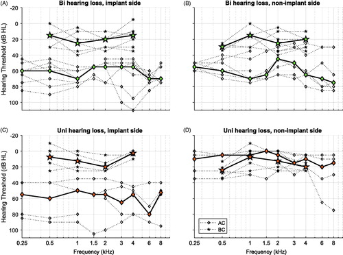 Figure 1. Audiograms of the 12 study subjects: (A and B) Seven subjects with bilateral hearing loss; and (C and D) five subjects with unilateral hearing loss. Median values are indicated in bold line. Bi: bilateral; Uni: unilateral; AC: air conduction; BC: bone conduction.