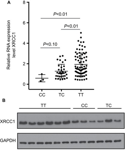 Figure 3 Effect of rs3213245 polymorphism on XRCC1 expression in OS patients.Notes: (A) XRCC1 mRNA expression in OS tumor tissues was detected by qRT-PCR. (B) XRCC1 protein levels were evaluated by Western blotting; OS patients with TT genotype (n=6); OS patients with CC genotype (n=3); OS patients with TC genotype (n=3).Abbreviations: OS, osteosarcoma; qRT-PCR; quantitative real-time PCR; XRCC1, X-ray repair cross-complementing group-1.