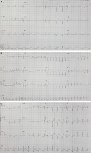 Figure 1 Exercise stress ECGs.