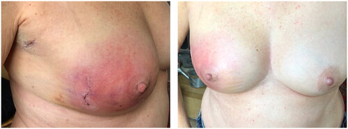 Figure 1. (POD7) Breast erythema that was managed as a simple surgical wound infection.