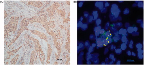Figure 4. Immunohistochemistry text of ROS1 and fluorescence in situ hybridization (FISH) test of ROS1 fusion.