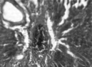 Figure 6 Thickening of blood vessels caused by CCl4 administration (H&E, × 10).