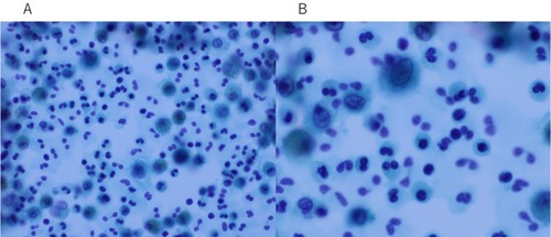 Figure 3 BAL fluid showed increased numbers of eosinophils with Papanicolaou staining (A, ×400). Under high magnification, the eosinophils were stained light green with nuclear localization (B, ×800).