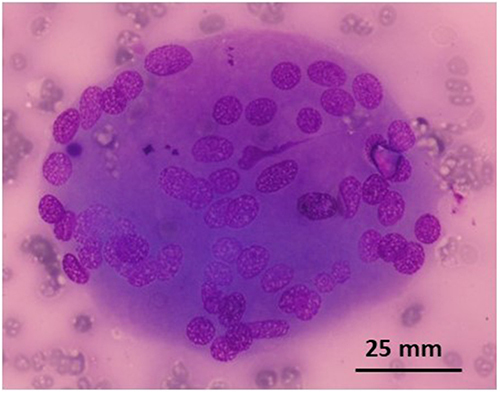 Figure 2 Large multinucleated giant cell with 60 nuclei (Giemsa, x400).