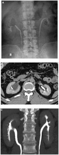 Figure 4 Right renal cyst. (A) Intravenous urography shows a lucent defect at the right upper pole displacing the calyces. (B and C) Axial computed tomography and computed tomography urography show a right upper polar renal cyst displacing the uppercalyces.
