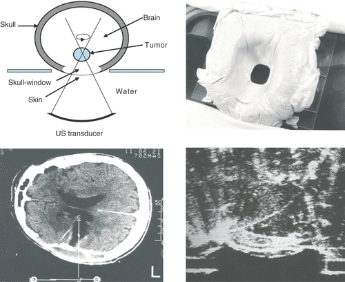 Figure 1. Ultrasound guided focused ultrasound treatment of brain tumors as described in Citation[22]. Top, Left: A diagram of the treatment setting showing the skull window through which the beam is propagating into the tumor. Right: A foam mold made for each of the patients to allow positioning of the head. The mold has a hole through which the ultrasound is propagating in to the brain. Bottom, Left: A CT image of a patient in a treatment position in the head mold. The image shows a thermocouple probe that was inserted to monitor and guide the treatments. In this case the prior surgery had removed most of the tumor (shown as a fluid filled cavity with tumor in the enhancing rim). Right: An ultrasound image of a patient during the treatment showing a thermocouple probe and the tumor.
