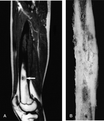 Figure 3. A) MR scan of a patient with a proximal femoral Ewing's sarcoma and a distal skip lesion which was not evident on the radiograph.B) Excised femur of the same patient, which has been split into two halves to show the primary and skip lesions.