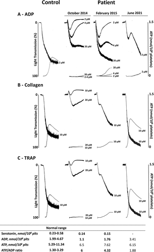 Figure 1. Platelet aggregation and ATP secretion of citrated PRP from the patient performed during the first visit (October 2014), and subsequent follow-up visits in February 2015 and June 2021, compared to control. Platelets were stimulated with ADP (A), collagen (B) and TRAP (C). Platelet serotonin and adenine nucleotides contents (nmol/108 platelets) at each visit are reported in the table.