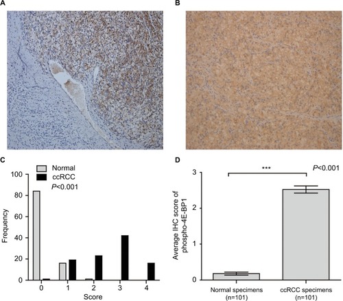 Figure 4 The protein expression of phospho-4E-BP1 in ccRCC.Notes: The protein expression level of phospho-4E-BP1 in ccRCC was measured using immunohistochemical staining. Representative adjacent normal renal tissues’ staining (A), ccRCC tissues’ staining (B), frequency distributions of protein expression across the cohort (C) and the average score of immunohistochemical staining (D) are shown. (A and B) Magnification ×100. ***P<0.001.Abbreviations: BP, binding protein; ccRCC; clear cell renal carcinoma; IHC, immunohistochemistry.